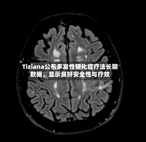 Tiziana公布多发性硬化症疗法长期数据，显示良好安全性与疗效